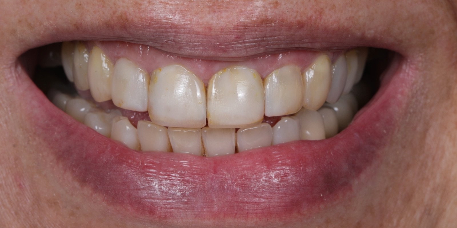 Sonrisa antes de las carillas