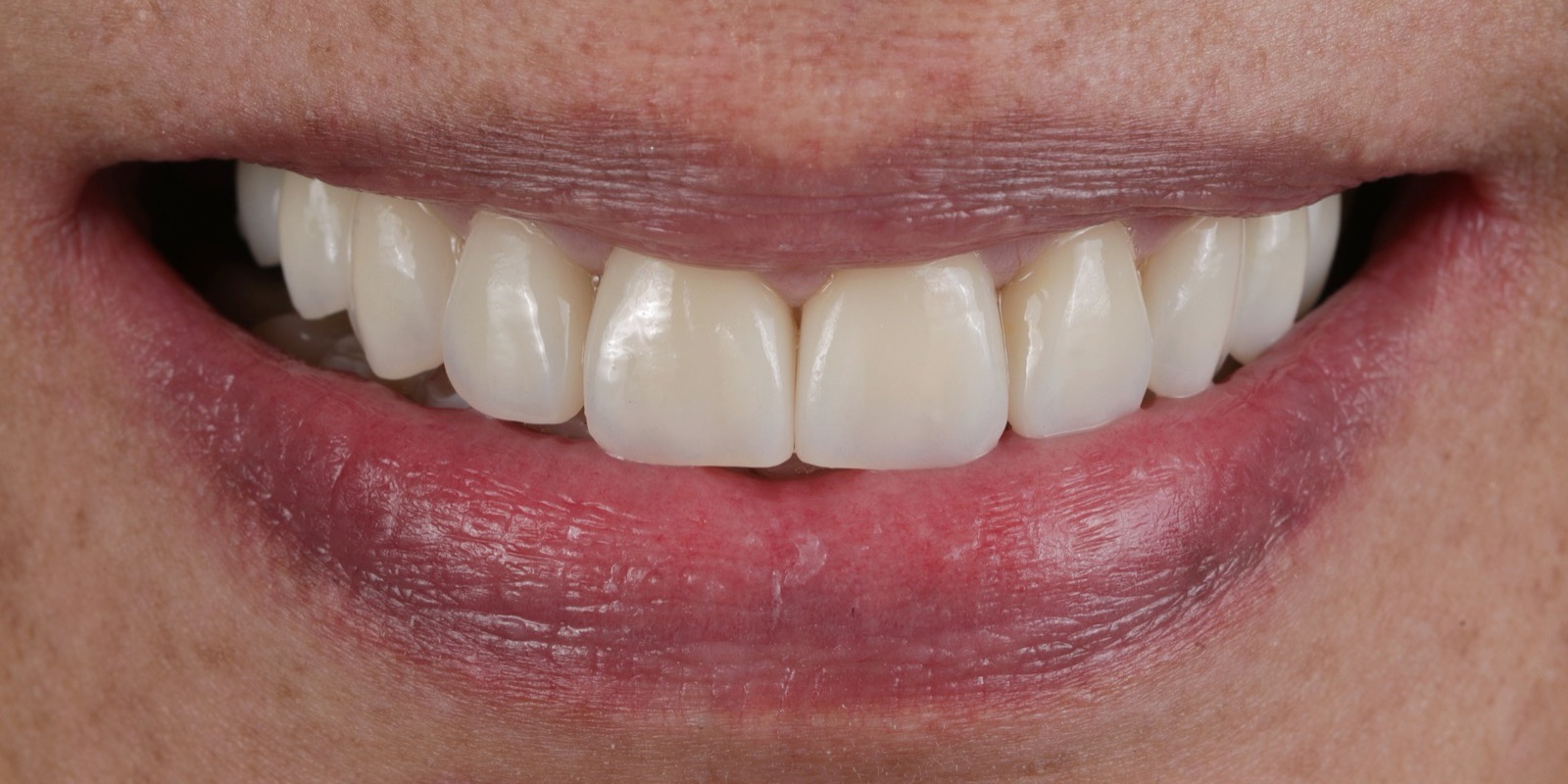 Sonrisa con carillas, después
