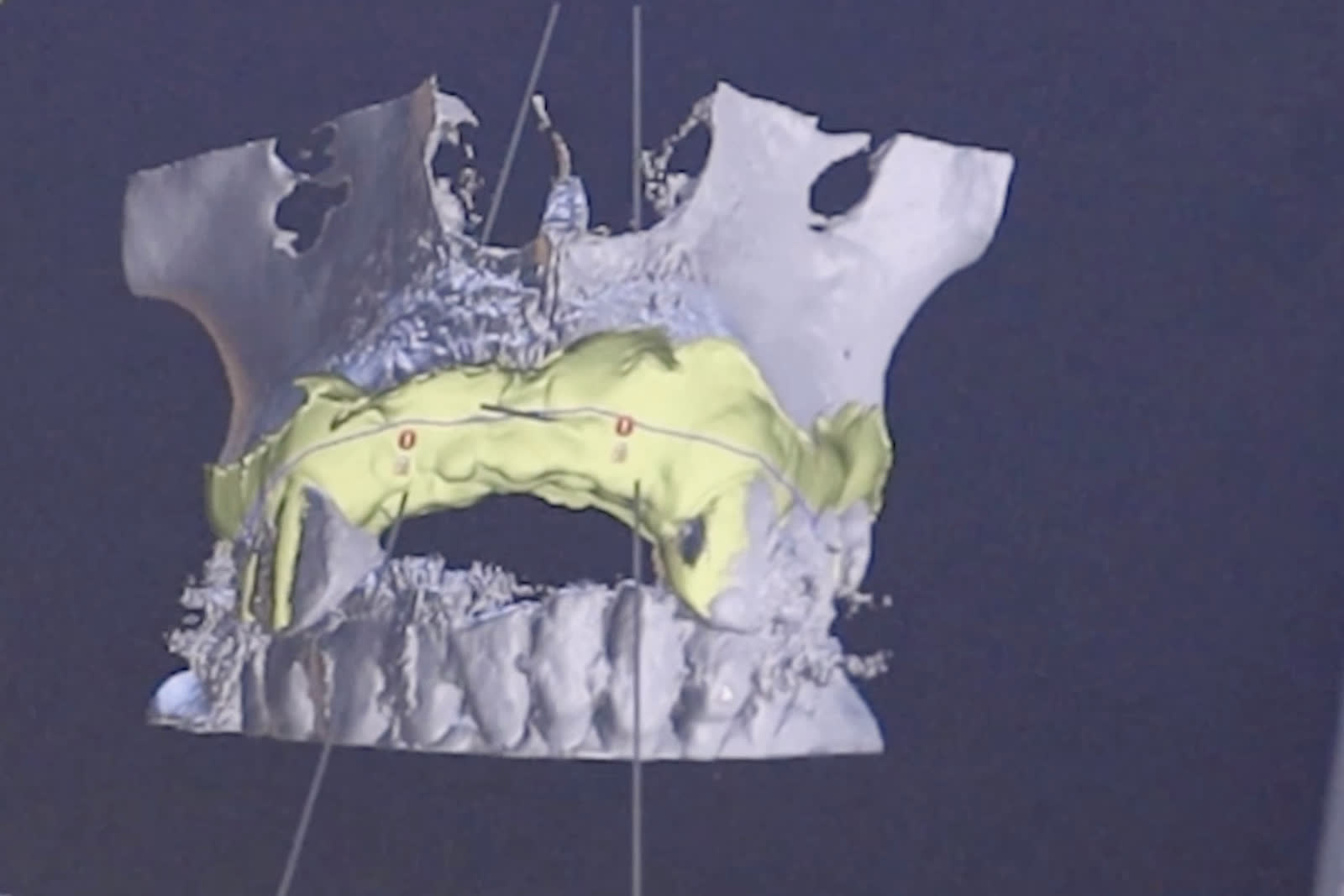 Planificación 3D sobre CBCT del caso