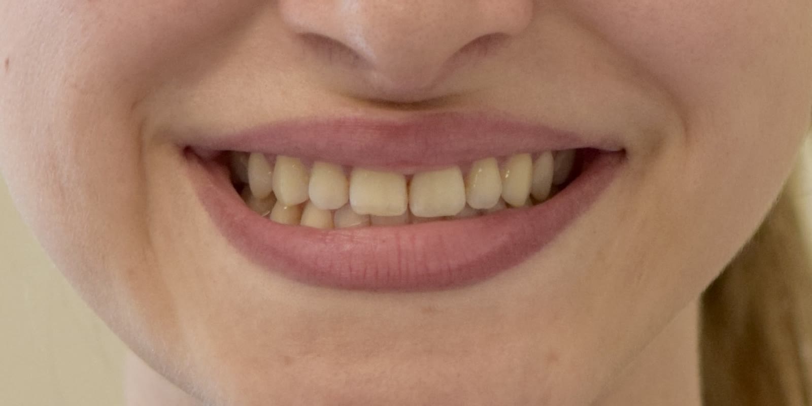 Dientes apiñados antes de la ortodoncia