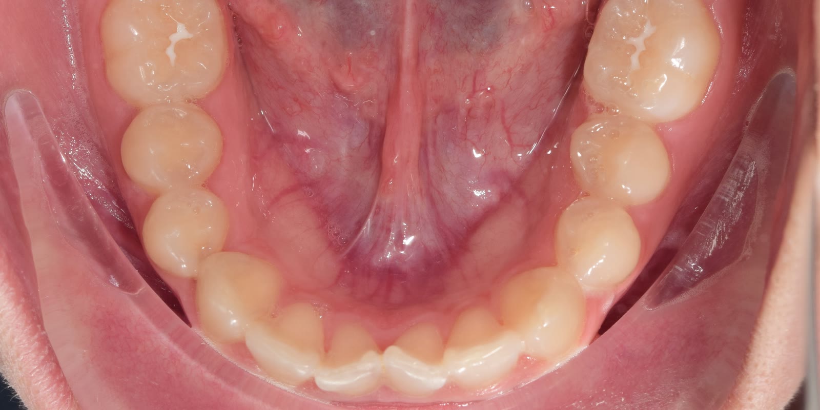 Antes: apiñamiento anteroinferior, vista oclusal