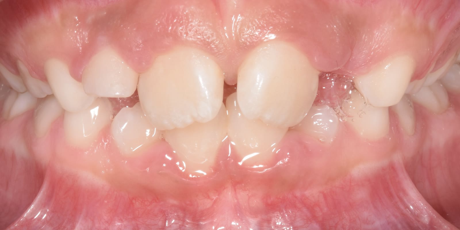 Antes: apiñamiento y posición dentaria alterada en dentición mixta