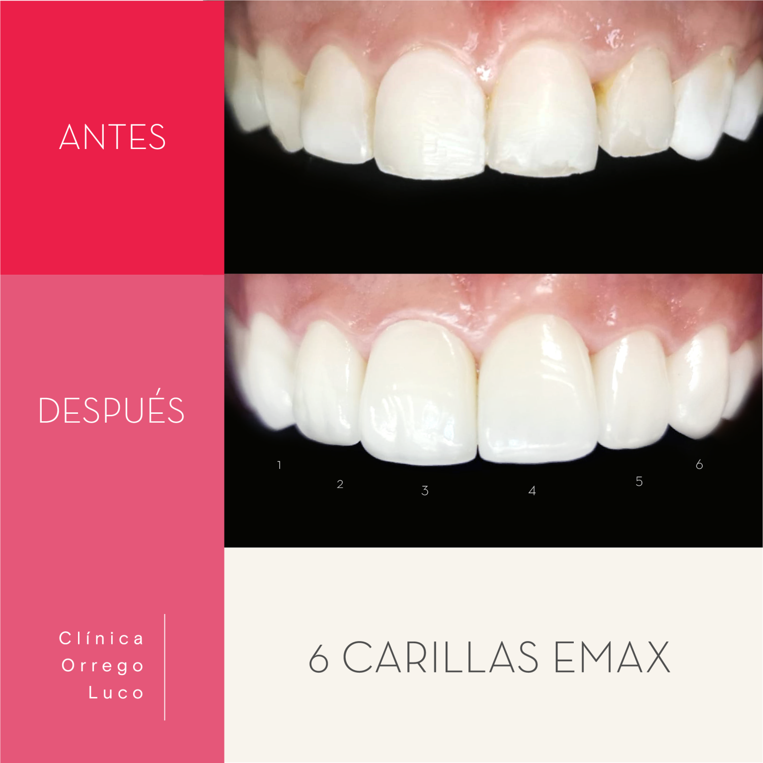 clinica orrego luco - caso clinico carillas