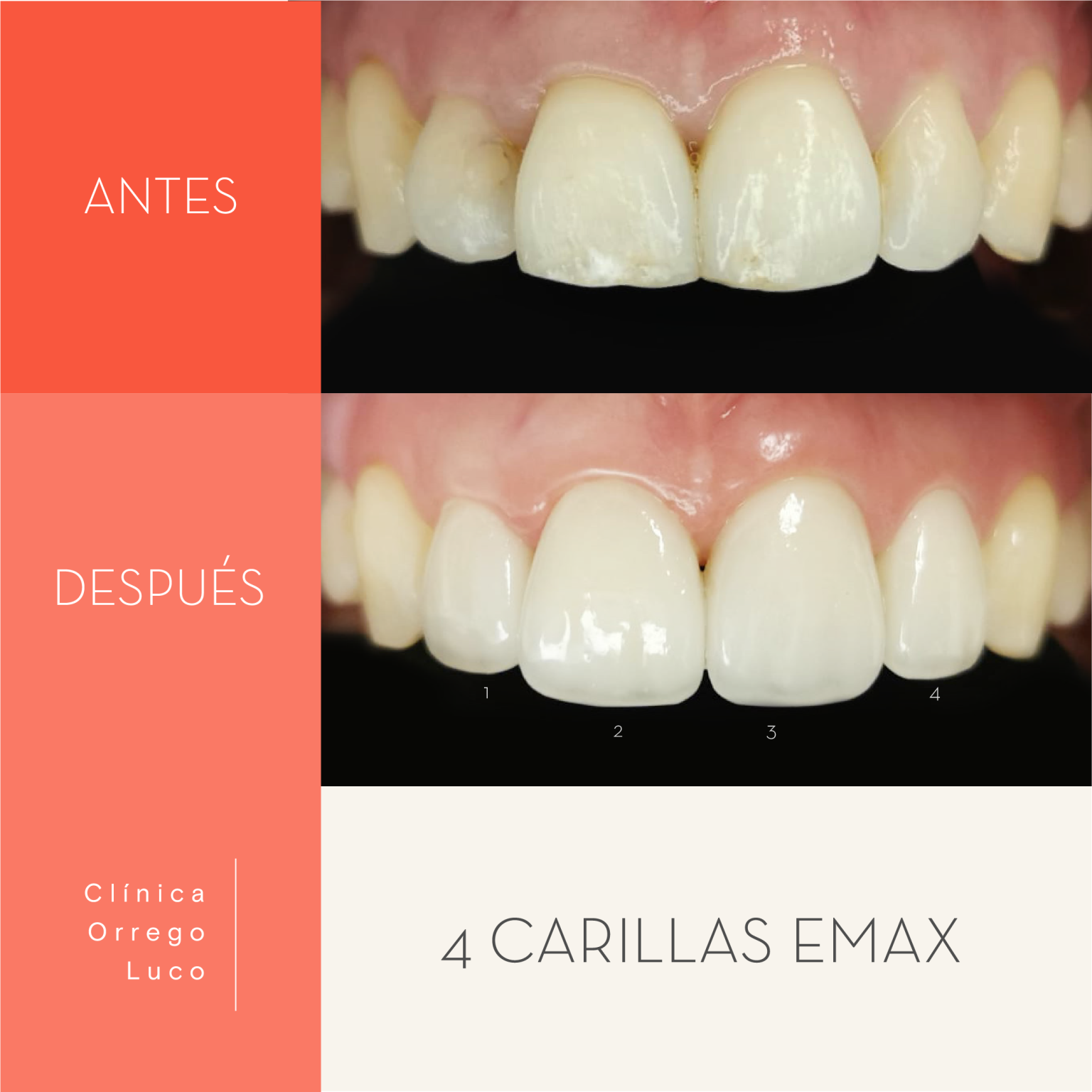 clinica orrego luco - caso clinico carillas