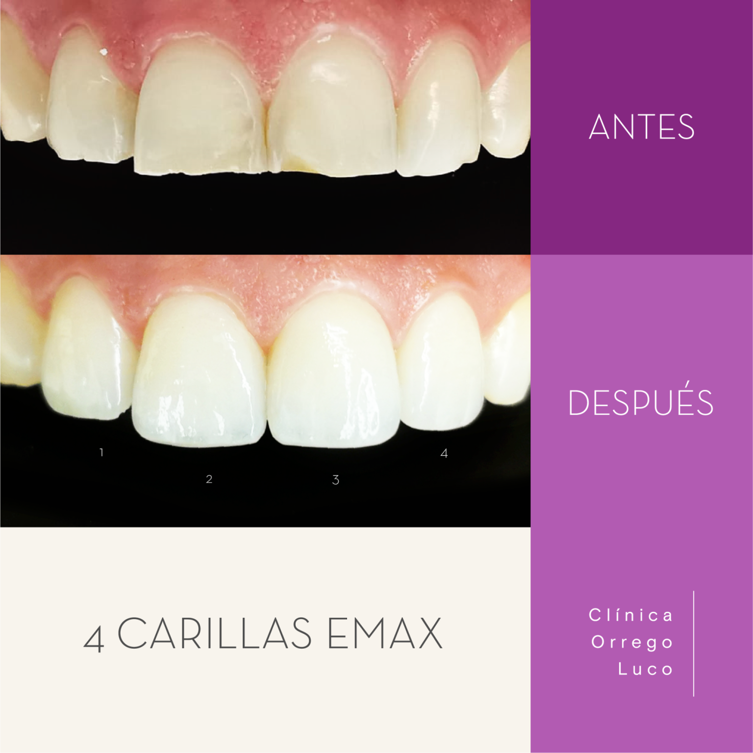 clinica orrego luco - caso clinico carillas