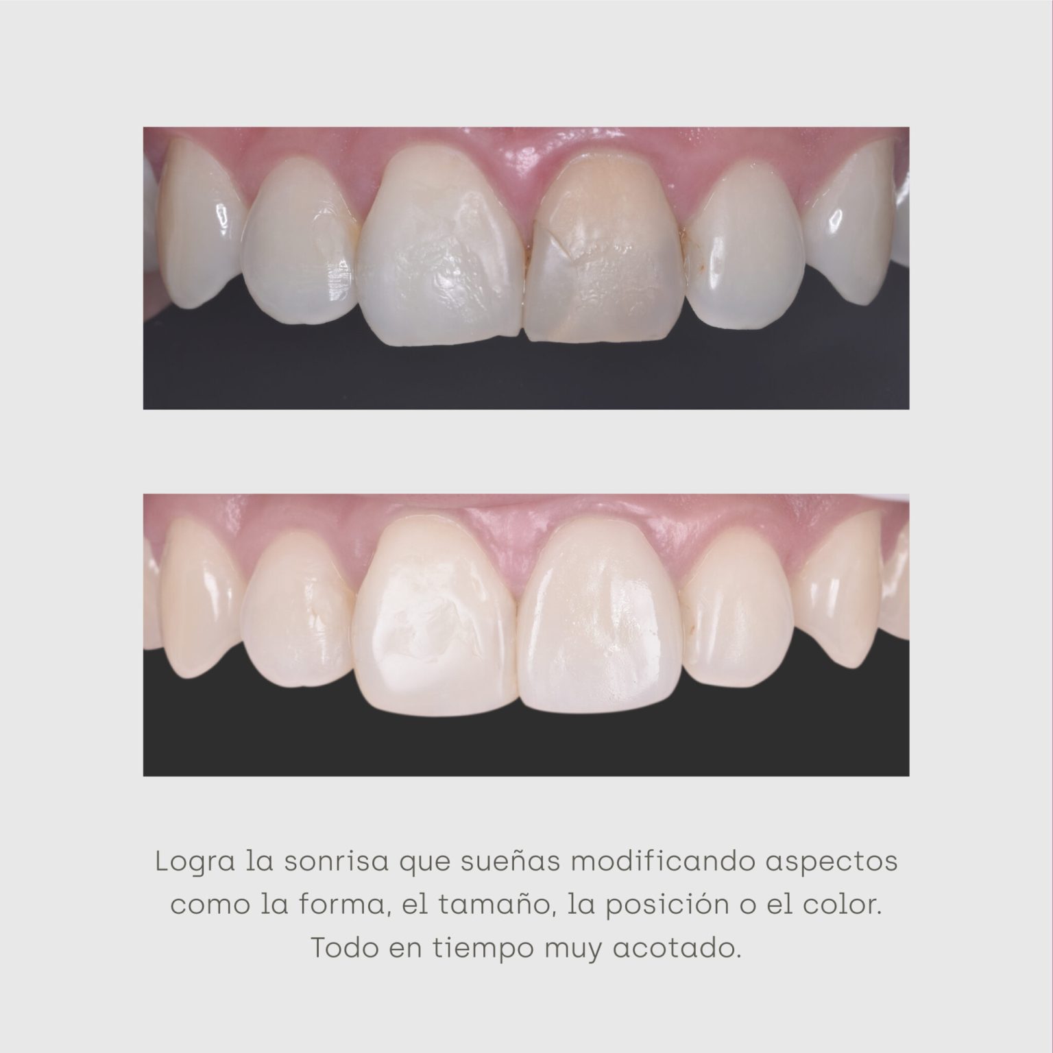 clinica orrego luco - caso clinico carillas y resina