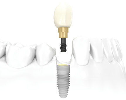 clinica orrego luco - implantes dentales