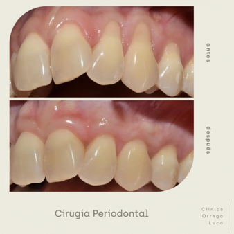 clinica orrego luco - cirugia periodontal